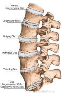 Understanding Slipped Disc in Dogs: Causes, Symptoms, and Effective Treatments