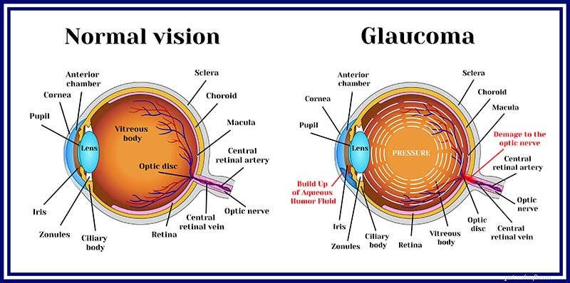 Glaucoma em cães:causas, sinais, tratamento